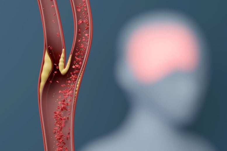 A Promising Way To Reverse Cognitive Decline Just Failed a Major Clinical Test