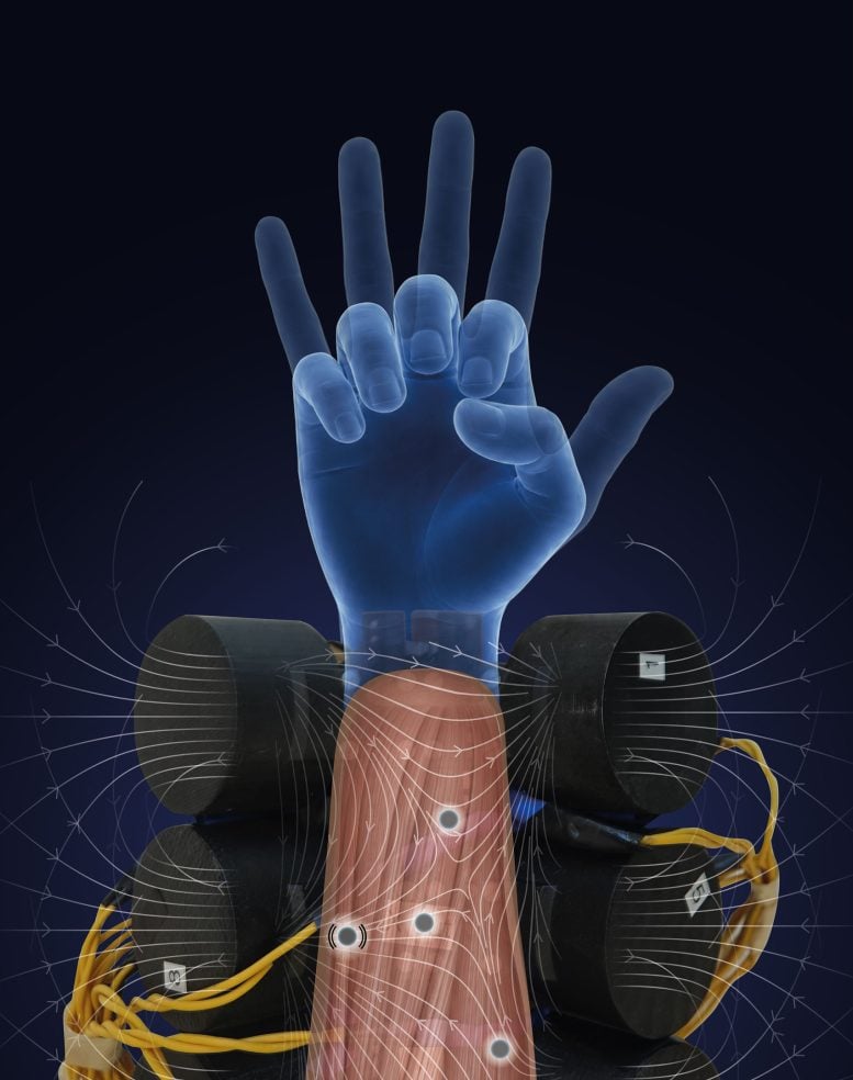 Tiny Magnets Implanted in Muscles Are Giving Prosthetic Hands a Remarkable New Ability